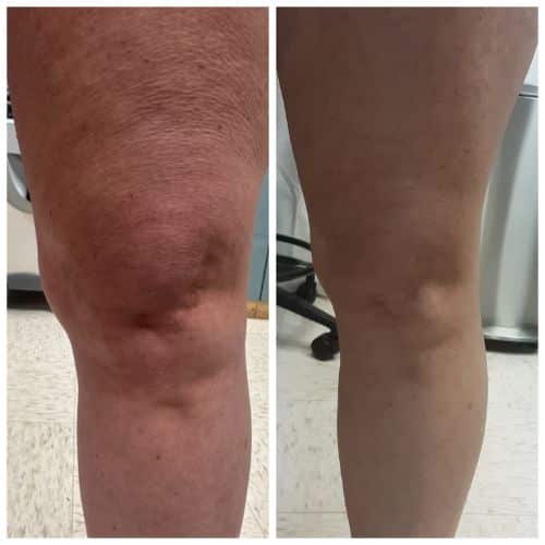 empowerRF before and after results knee cellulite treatment skin tightening