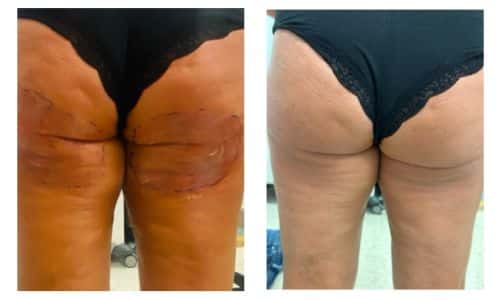 empowerRF before and after results back thighs cellulite treatment skin tightening