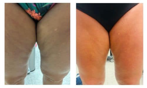 empowerRF before and after results thighs cellulite treatment skin tightening