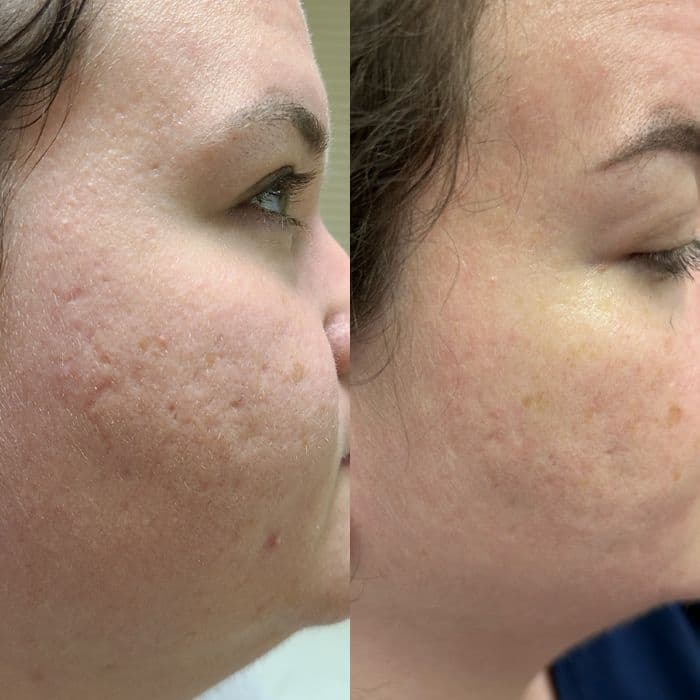 Transformation Morpheus8 microneedling radiofrequency skin treatment acne scar before and after results